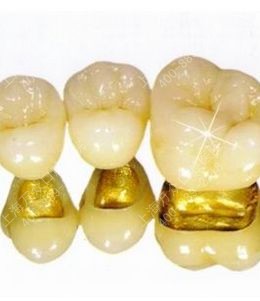 细说烤瓷牙的那些事,一篇文章让你充分了解烤瓷牙