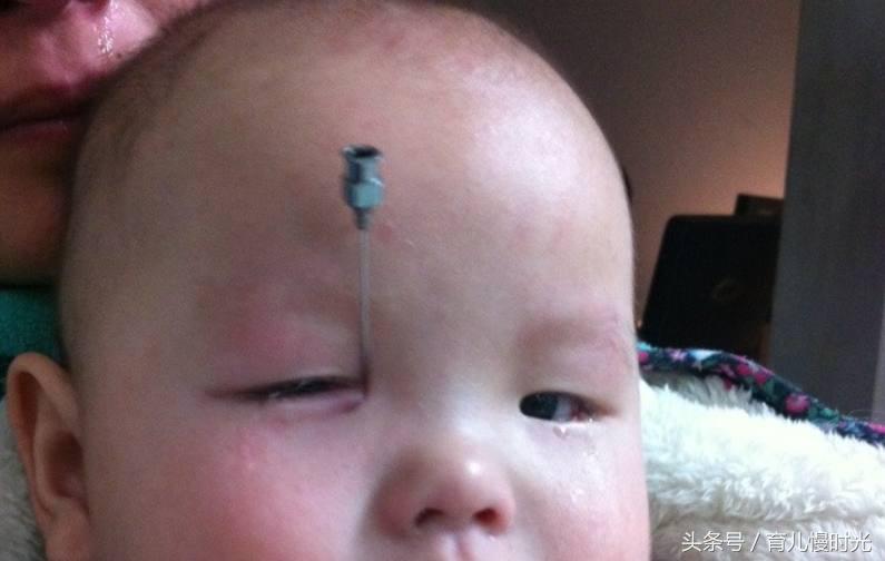 三岁宝宝眼屎多怎么按摩,左眼眼屎多按摩什么穴位去眼屎