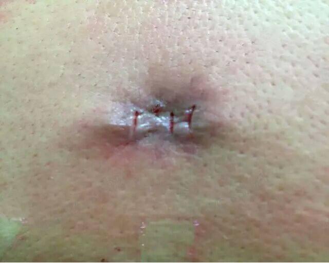 痣上长小疙瘩是什么原因,痣小比较深怎么办