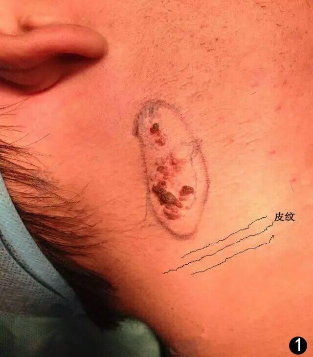 痣上长小疙瘩是什么原因,痣小比较深怎么办