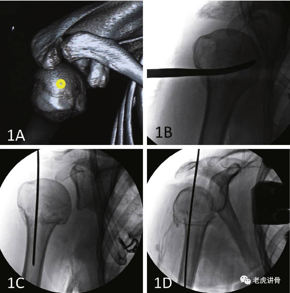 肱骨骨折髓内钉手术全过程,肱骨近端骨折髓内钉的治疗方案