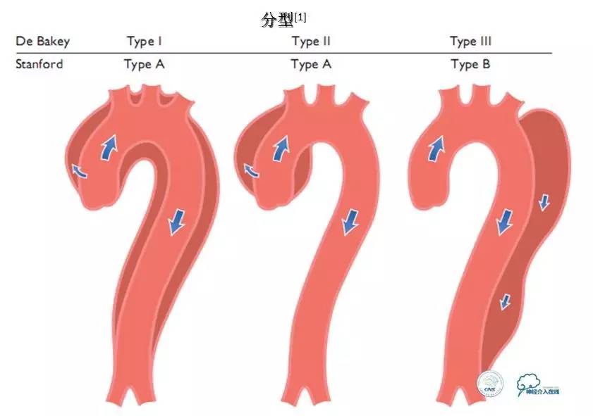主动脉夹层引起的脑梗后遗症,颈动脉狭窄缺血性脑梗