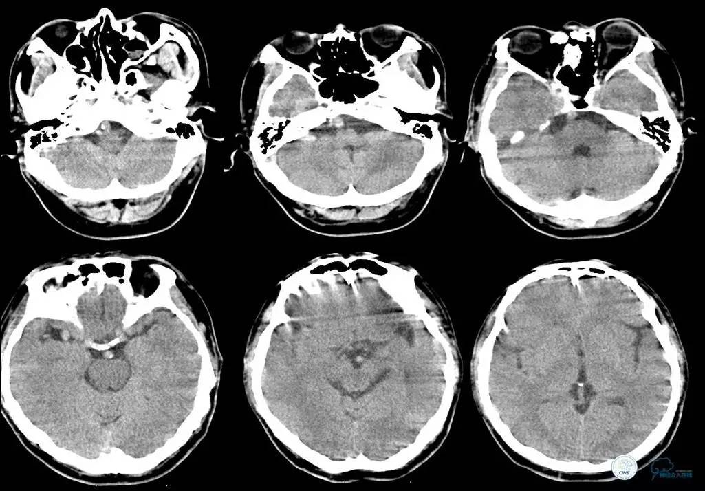 主动脉夹层引起的脑梗后遗症,颈动脉狭窄缺血性脑梗