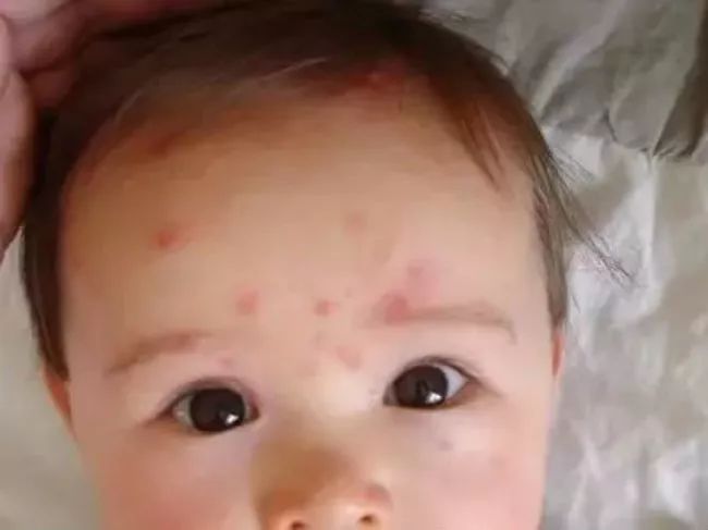 每个小朋友都会出水痘吗,孩子出水痘应该注意哪些问题