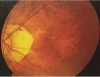 高度近视有必要恐慌吗,高度近视不戴眼镜的危害