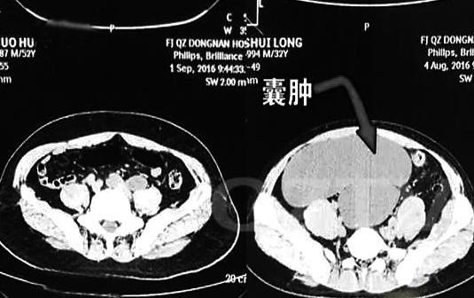 4个肾的人会发生什么,天生只有一个肾的概率是多少