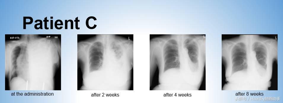 肺癌胸腔积液缓解办法,肺癌出现胸腔积液怎么治疗