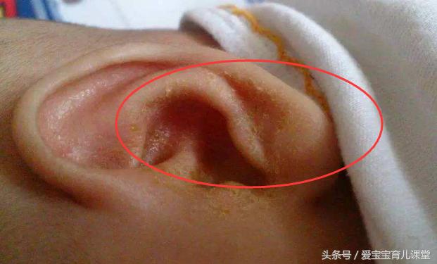 小孩子不容易得中耳炎,妈妈得了中耳炎