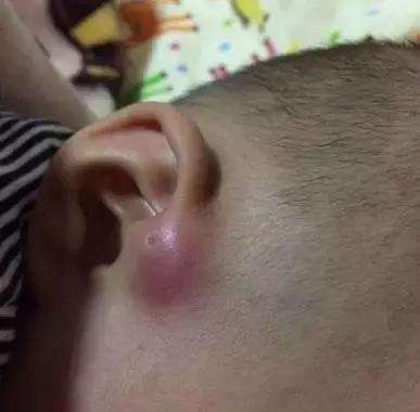 宝宝眼睑发炎里面有脓点,宝宝眼皮经常肿最后化脓