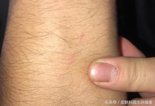 伊可尔治疗扁平疣,大的扁平疣怎么治疗呢