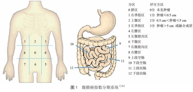 结直肠癌腹膜转移诊治中国专家意见(2017)