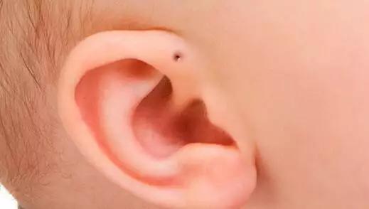 宝宝眼睑发炎里面有脓点,宝宝眼皮经常肿最后化脓