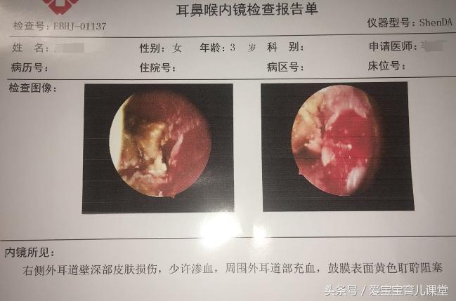小孩子不容易得中耳炎,妈妈得了中耳炎