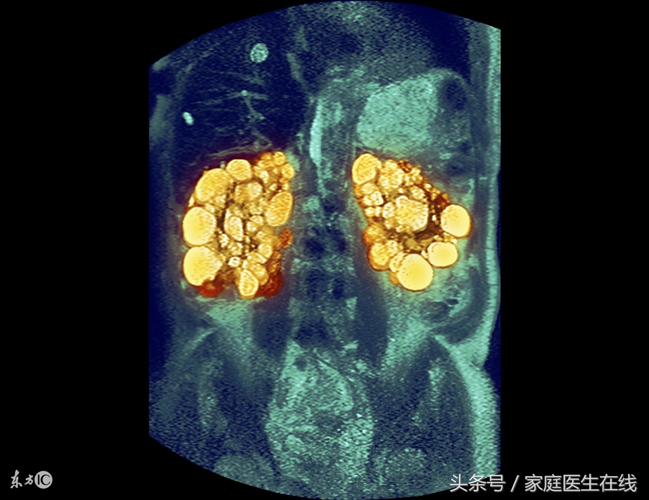 确诊糖尿病可以不治疗吗,得了糖尿病不治疗会有什么后果