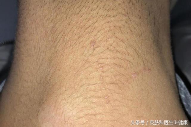 伊可尔治疗扁平疣,大的扁平疣怎么治疗呢