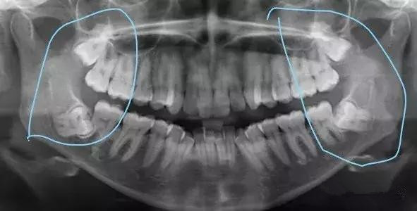智齿长歪了把邻牙挤坏了,智齿挤歪了会自己恢复吗