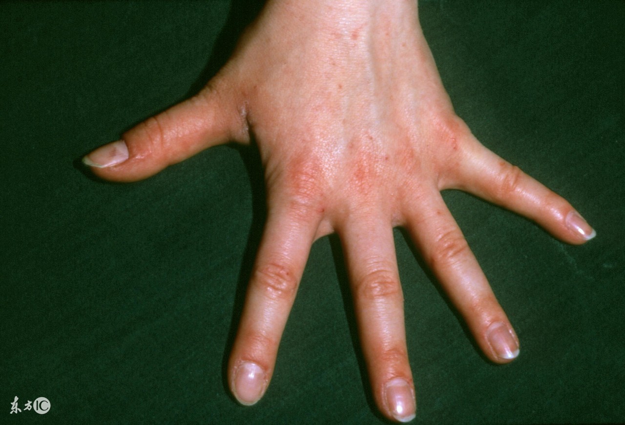 预防疥疮应采取以下措施,治疗疥疮最有效的方法