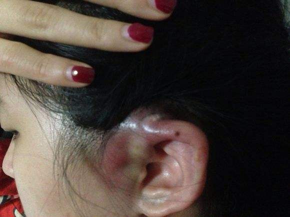 宝宝眼睑发炎里面有脓点,宝宝眼皮经常肿最后化脓