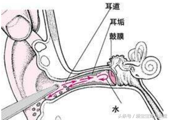 小孩子不容易得中耳炎,妈妈得了中耳炎