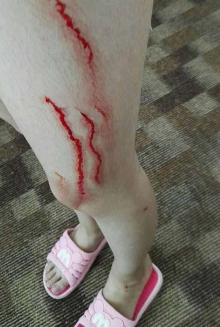 打架脸肿了怎么处理,打架脸肿怎么处理