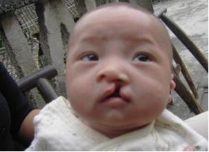 当心！3种药物4种习惯易致胎儿“兔唇”