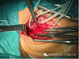 胃溃疡的溃疡点在主动脉,胃动脉溃疡