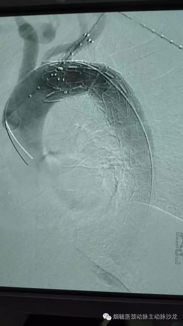 胃溃疡的溃疡点在主动脉,胃动脉溃疡