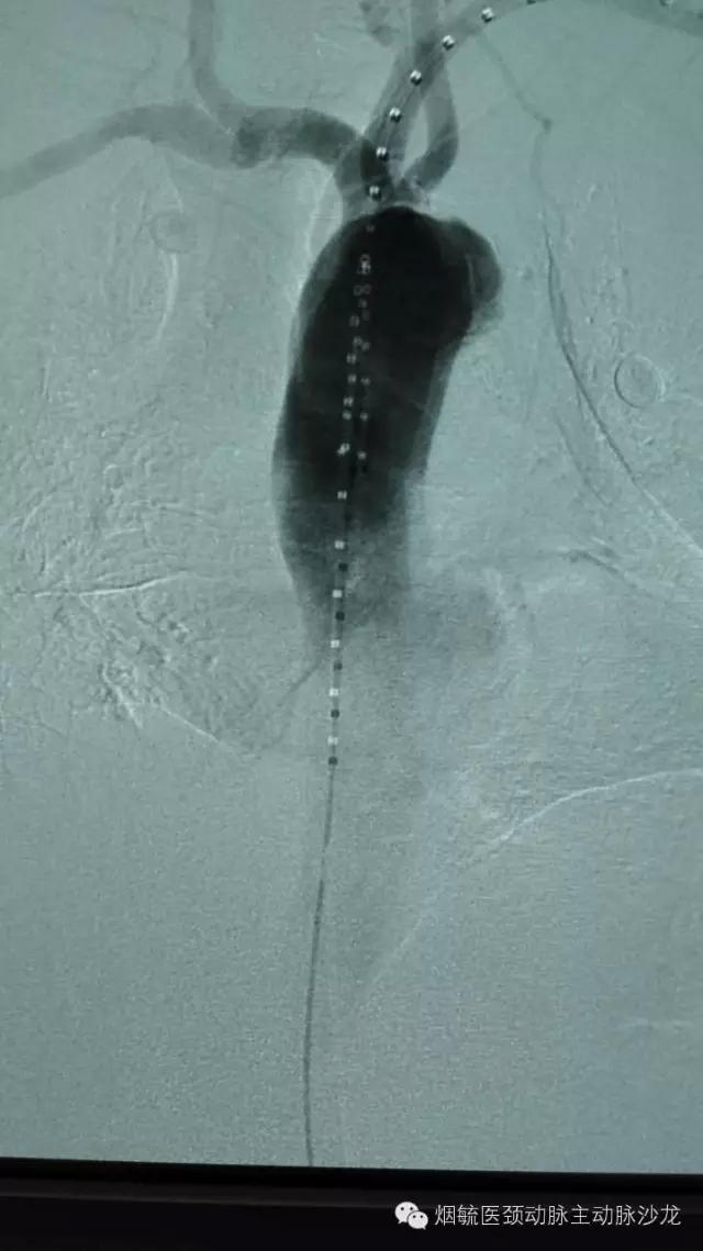 胃溃疡的溃疡点在主动脉,胃动脉溃疡