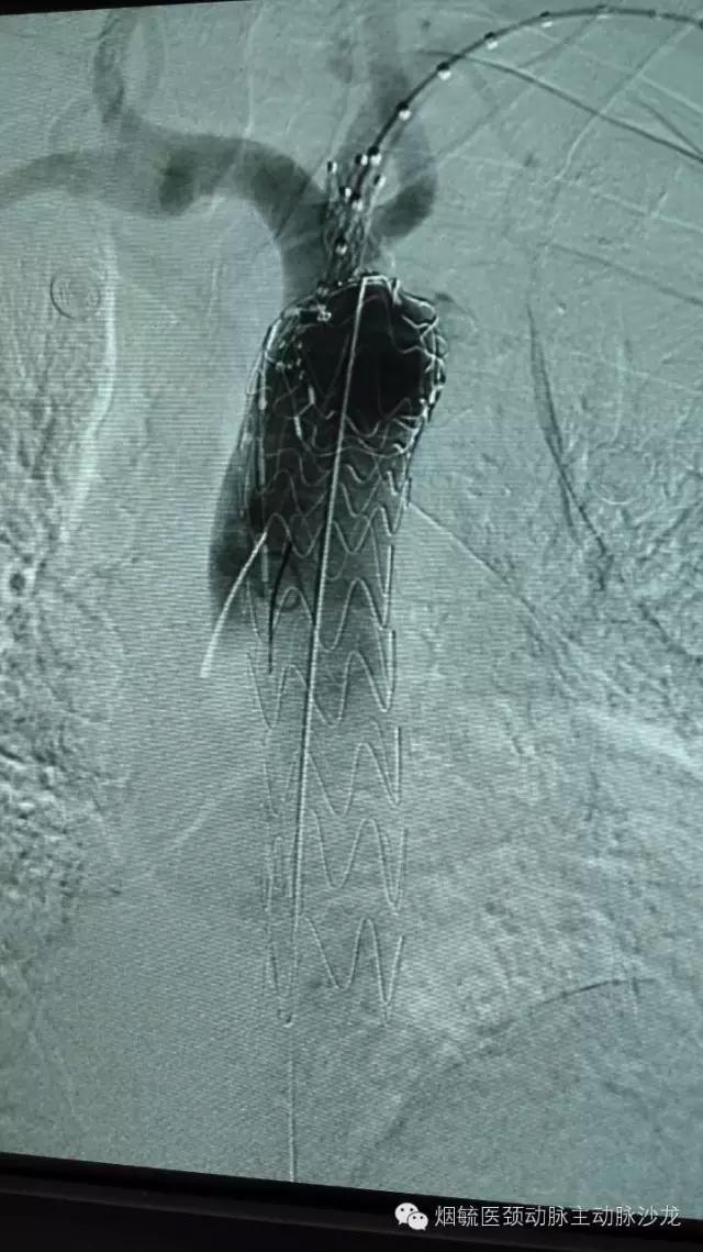 胃溃疡的溃疡点在主动脉,胃动脉溃疡