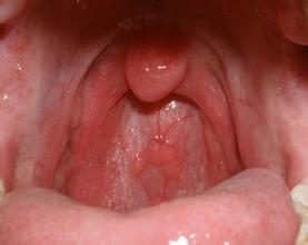 扁桃体化脓痛苦,扁桃体周围脓肿最常见的症状