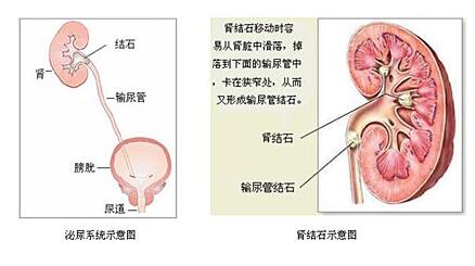 肾结石是什么原因造成的怎么办,肾结石是什么原因造成的怎么治