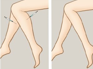 打了瘦腿针走路多影响效果吗,小腿第三次打瘦腿针还会有效果吗
