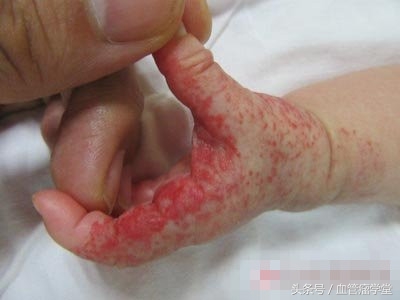 关于血管瘤的问题,医生科普血管瘤的治疗方法有哪些