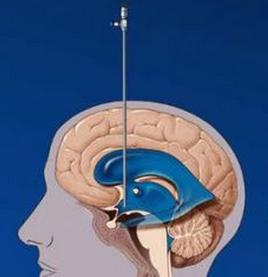 脑出血手术后怎样预防脑积水增多,脑积水可以做预防性脑照射吗