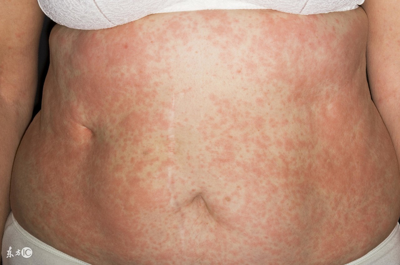 丘疹性荨麻疹可以打麻疹疫苗吗,丘疹性荨麻疹和麻疹应该怎么区分