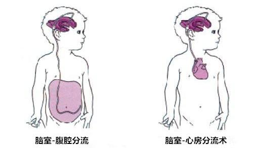 脑出血手术后怎样预防脑积水增多,脑积水可以做预防性脑照射吗