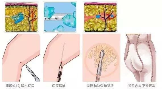 面部吸脂脸部松弛怎么办,肚子吸脂后松弛怎么锻炼