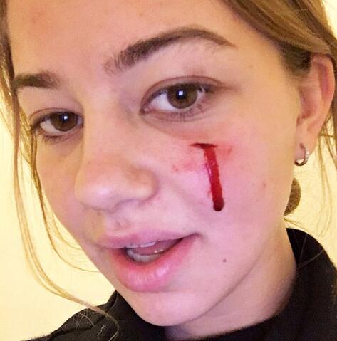 打架脸肿了怎么处理,打架脸肿怎么处理