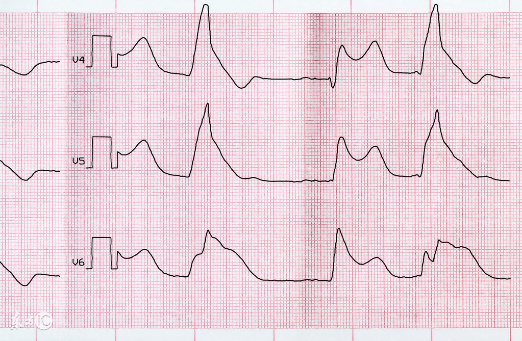 频发室性早搏可以做全麻手术吗,室性早搏射频消融能彻底祛除吗
