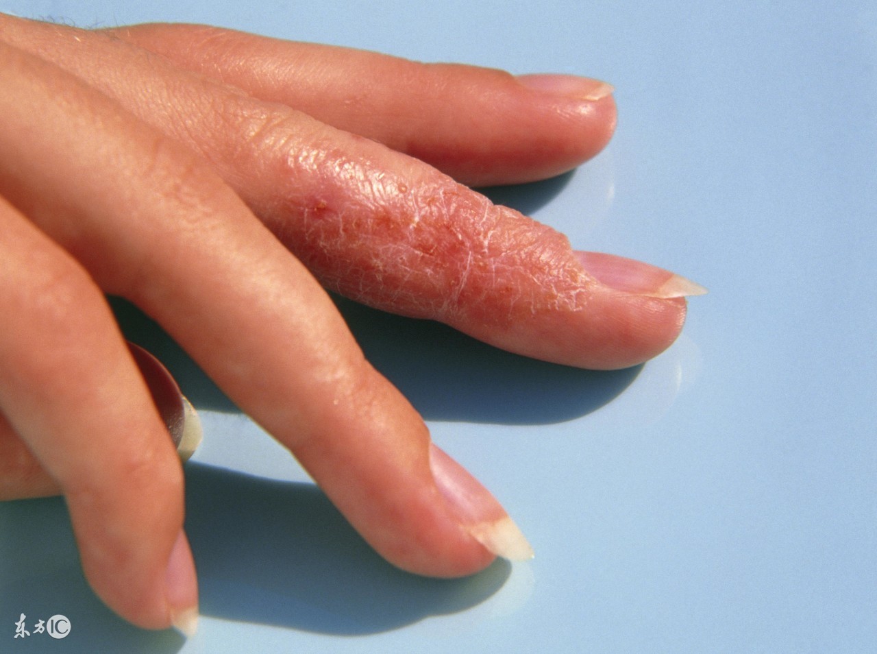 手部湿疹和手癣的鉴别要点主要为,怎么分辨湿疹和手癣