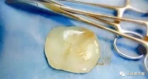 全球仅有10几例,宝宝带“玉”出生!原来是因为……