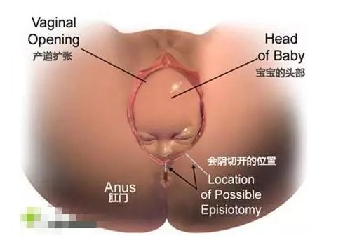 生孩子,你需要做会阴侧切么?