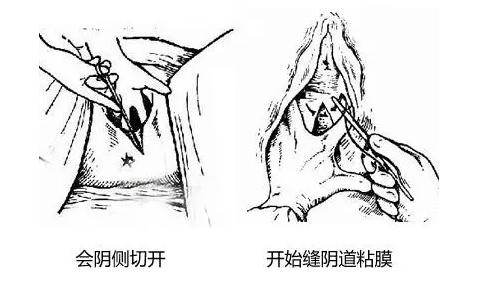 生孩子,你需要做会阴侧切么?