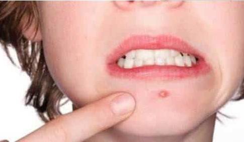 脸蛋上长痘痘是什么原因,来大姨妈长痘痘什么原因