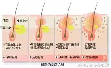 为什么一直反复长粉刺好了又长,脸上长粉刺如果什么都用会好吗