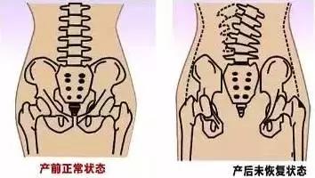 哪些人不适合做产后骨盆修复,不做骨盆修复自己能恢复好吗
