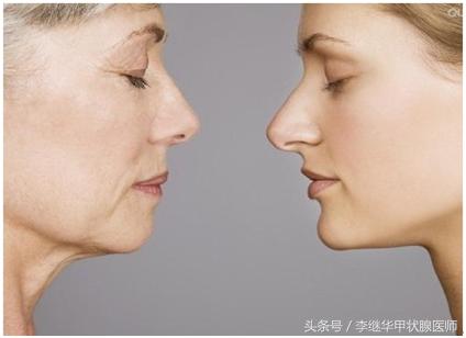 面容憔悴衰老是气血不足吗,甲减会延缓人的衰老吗