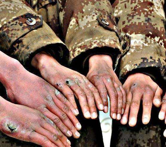 脚上冻疮怎么办,根治冻疮特效药