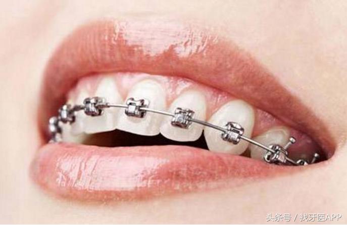牙齿矫正能不能只矫正一半的牙齿，矫正牙齿能不能只做半口