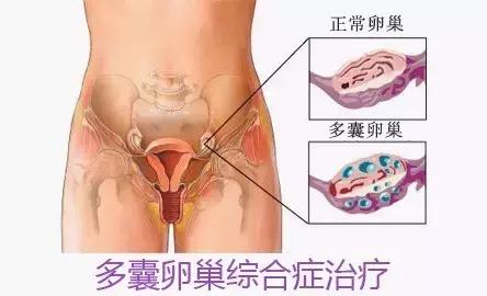 为什么50%的不孕女性这里会长毛?